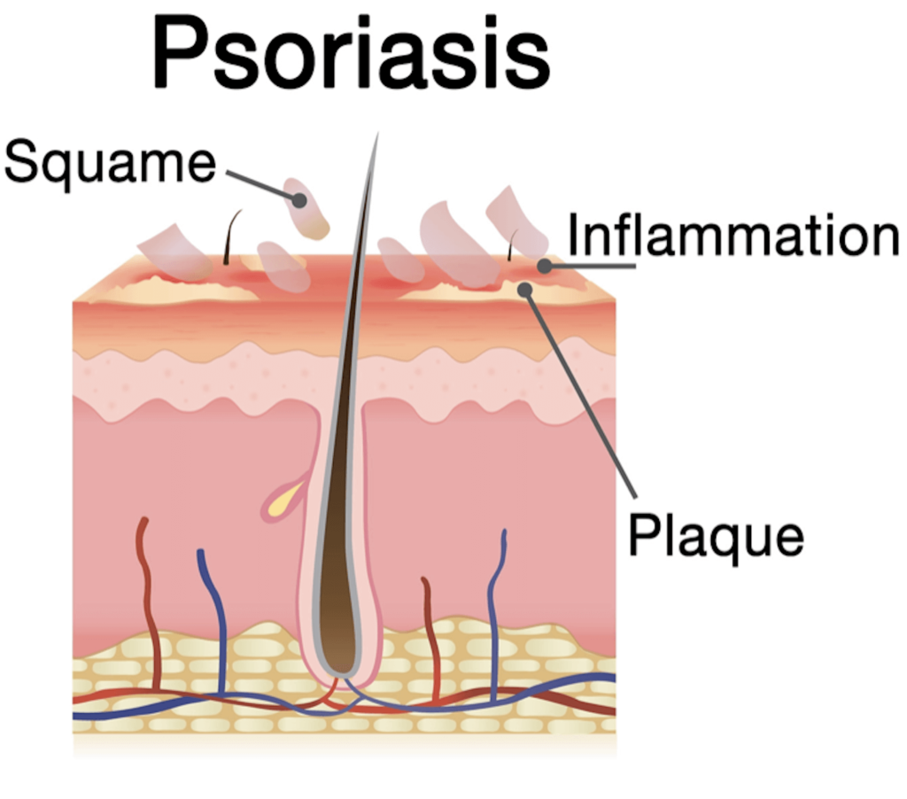 psoriasis effet sur la peau